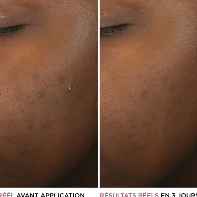 It CosmeticsBye Bye Breakout Sérum anti-acné à l'acide salicylique